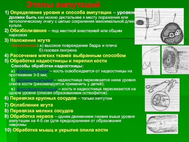 Этапы ампутаций 1) Определение уровня и способа ампутации – уровень должен быть