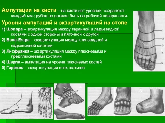 Ампутации на кисти – на кисти нет уровней, сохраняют каждый мм.; рубец