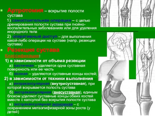 Артротомия – вскрытие полости сустава 1) самостоятельная операция – с целью дренирования