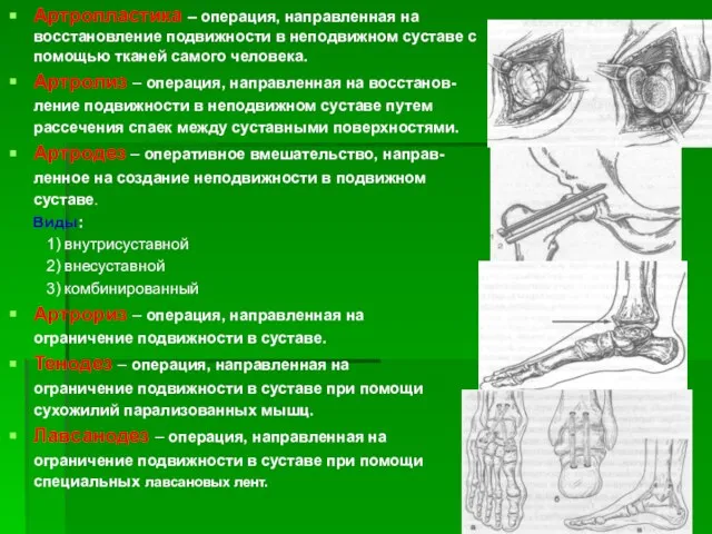 Артропластика – операция, направленная на восстановление подвижности в неподвижном суставе с помощью