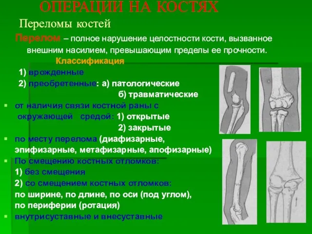 ОПЕРАЦИИ НА КОСТЯХ Переломы костей Перелом – полное нарушение целостности кости, вызванное