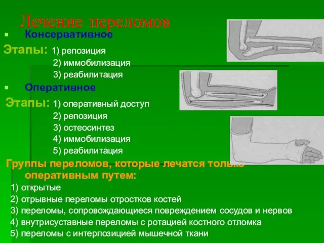 Лечение переломов Консервативное Этапы: 1) репозиция 2) иммобилизация 3) реабилитация Оперативное Этапы: