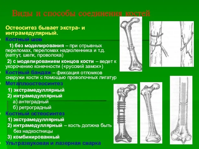 Виды и способы соединения костей Остеоситез бывает экстра- и интрамедулярный. Костный шов