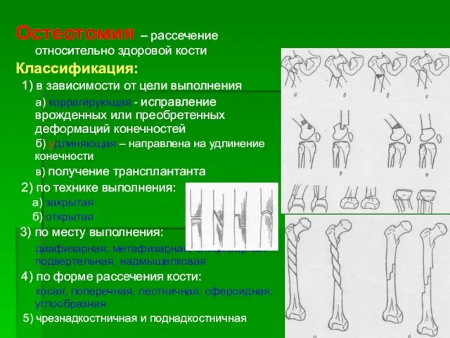 Остеотомия – рассечение относительно здоровой кости Классификация: 1) в зависимости от цели