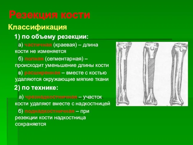 Резекция кости Классификация 1) по объему резекции: а) частичная (краевая) – длина