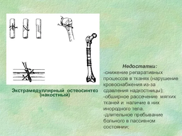 Недостатки: -снижение репаративных процессов в тканях (нарушение кровоснабжения из-за сдавления надкостницы); -обширное