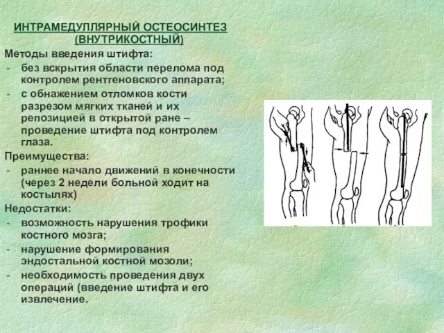 ИНТРАМЕДУЛЛЯРНЫЙ ОСТЕОСИНТЕЗ (ВНУТРИКОСТНЫЙ) Методы введения штифта: без вскрытия области перелома под контролем