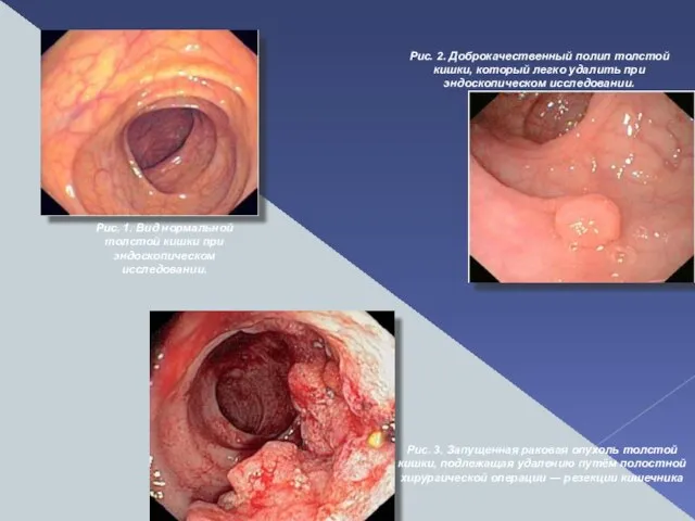 Рис. 1. Вид нормальной толстой кишки при эндоскопическом исследовании. Рис. 2. Доброкачественный