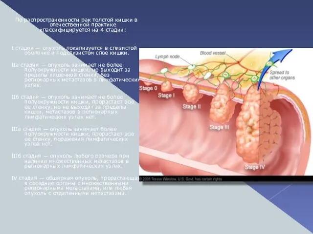 По распространенности рак толстой кишки в отечественной практике классифицируется на 4 стадии: