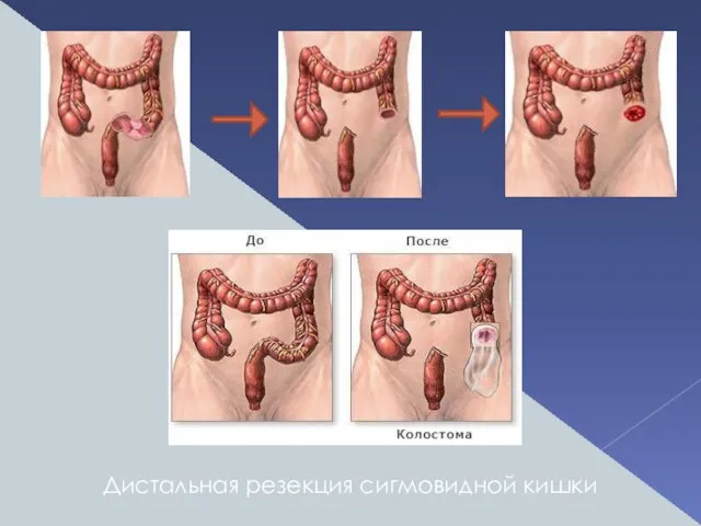 Дистальная резекция сигмовидной кишки