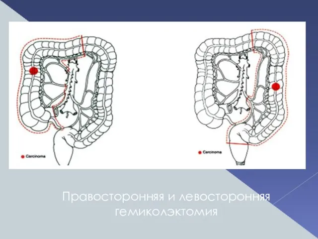 Правосторонняя и левосторонняя гемиколэктомия