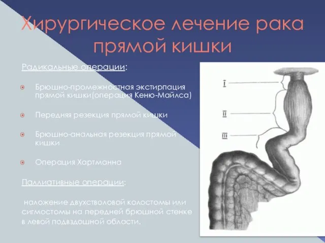 Хирургическое лечение рака прямой кишки Радикальные операции: Брюшно-промежностная экстирпация прямой кишки(операция Кеню-Майлса)