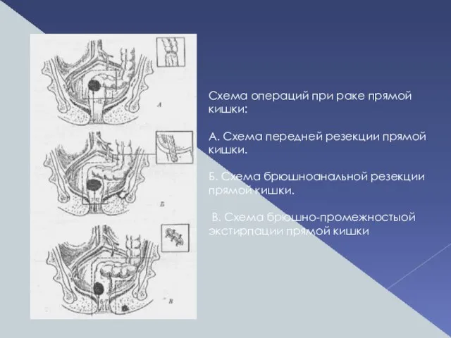 Схема операций при раке прямой кишки: А. Схема передней резекции прямой кишки.