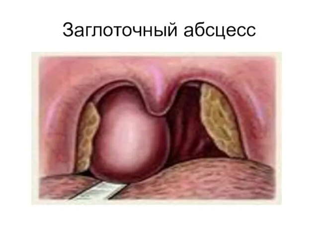 Заглоточный абсцесс