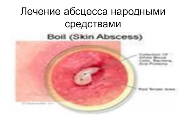 Лечение абсцесса народными средствами