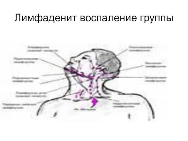 Лимфаденит воспаление группы