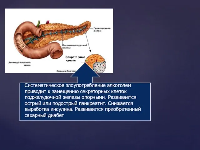 Секреторные клетки Систематическое злоупотребление алкоголем приводит к замещению секреторных клеток поджелудочной железы