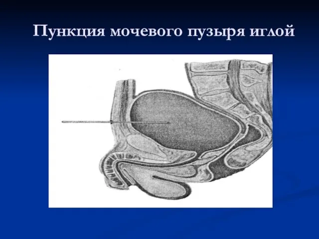 Пункция мочевого пузыря иглой