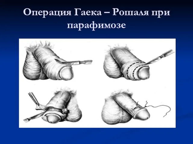 Операция Гаека – Рошаля при парафимозе