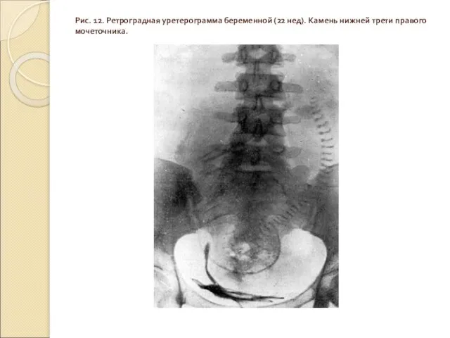 Рис. 12. Ретроградная уретерограмма беременной (22 нед). Камень нижней трети правого мочеточника.