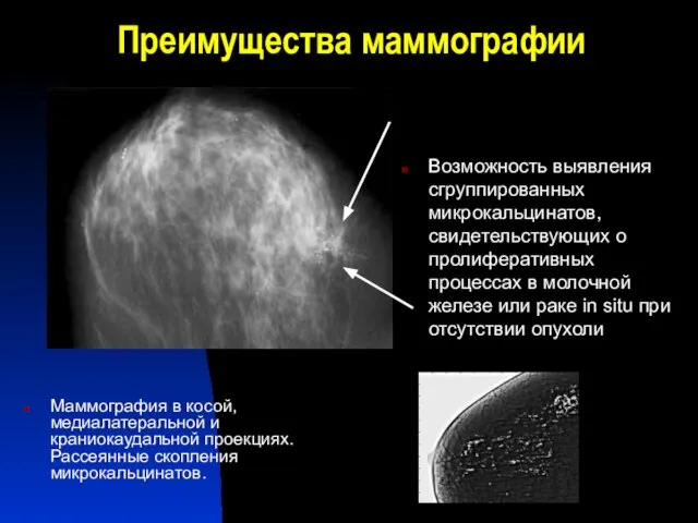 Преимущества маммографии Маммография в косой, медиалатеральной и краниокаудальной проекциях. Рассеянные скопления микрокальцинатов.