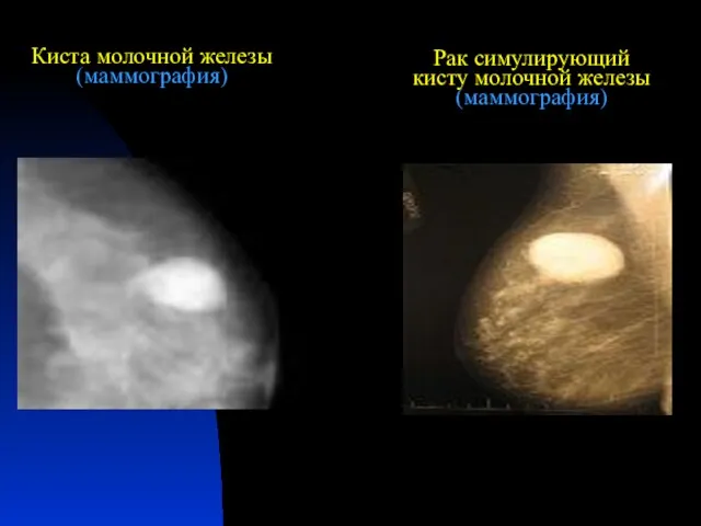 Киста молочной железы (маммография) Рак симулирующий кисту молочной железы (маммография)