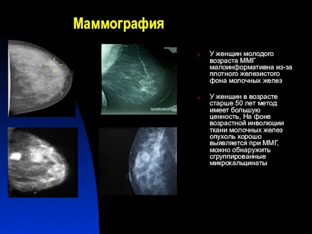 Маммография У женщин молодого возраста ММГ малоинформативна из-за плотного железистого фона молочных