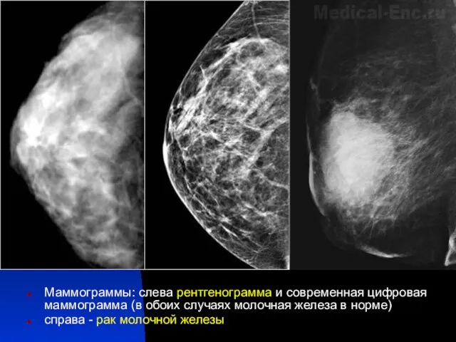 Маммограммы: слева рентгенограмма и современная цифровая маммограмма (в обоих случаях молочная железа