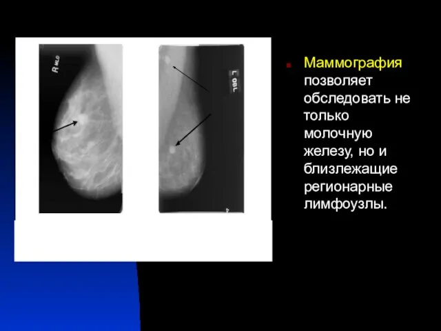 Маммография позволяет обследовать не только молочную железу, но и близлежащие регионарные лимфоузлы.