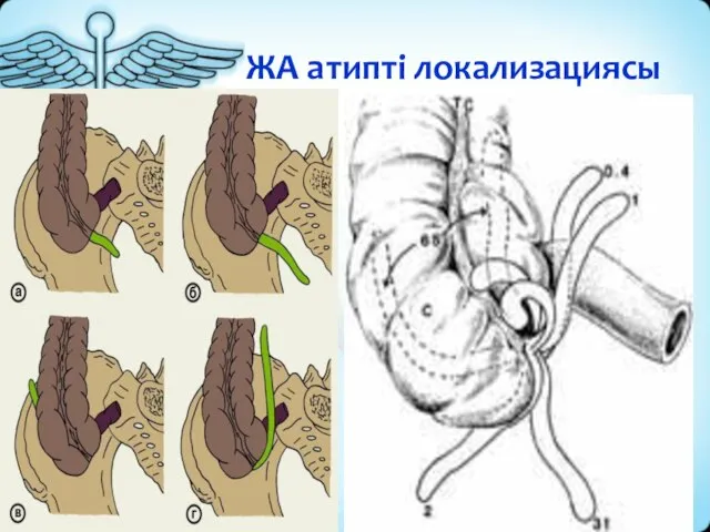 ЖА атипті локализациясы