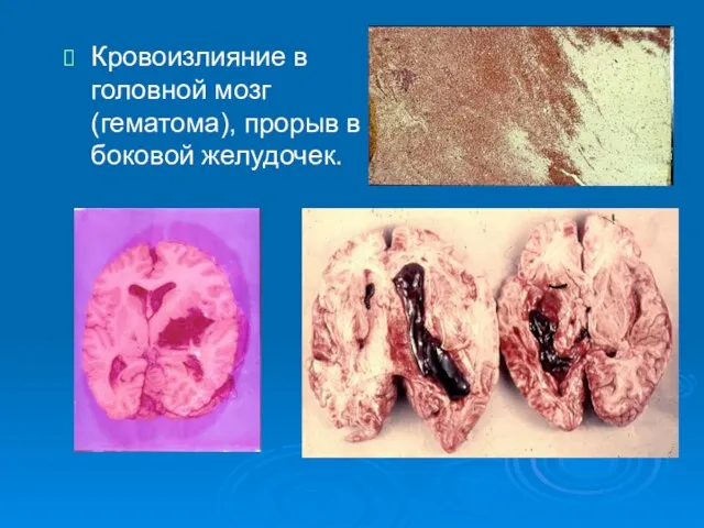 Кровоизлияние в головной мозг (гематома), прорыв в боковой желудочек.