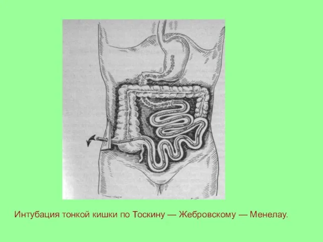 Интубация тонкой кишки по Тоскину — Жебровскому — Менелау.