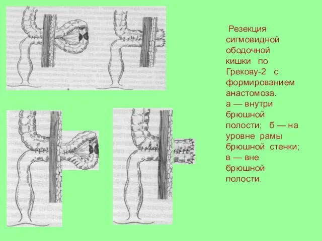 Резекция сигмовидной ободочной кишки по Грекову-2 с формированием анастомоза. а — внутри