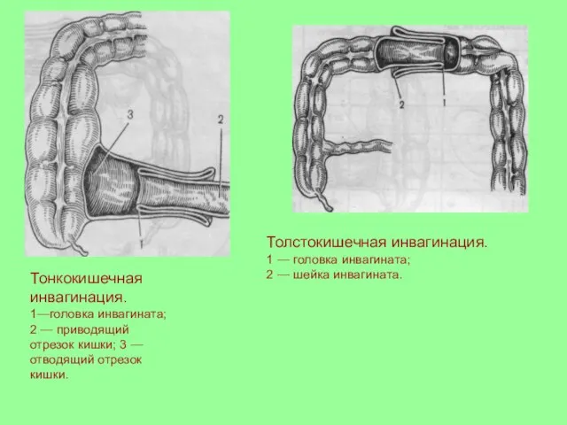 Тонкокишечная инвагинация. 1—головка инвагината; 2 — приводящий отрезок кишки; 3 — отводящий