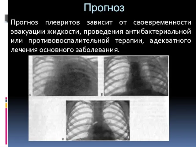 Прогноз Прогноз плевритов зависит от своевременности эвакуации жидкости, проведения антибактериальной или противовоспалительной