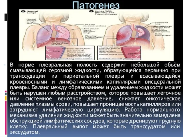 Патогенез В норме плевральная полость содержит небольшой объём смазывающей серозной жидкости, образующейся