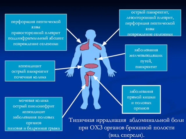 перфорация пептической язвы правосторонний плеврит поддиафрагмальный абсцесс повреждение селезенки аппендицит острый панкреатит