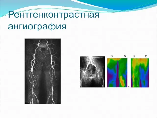 Рентгенконтрастная ангиография