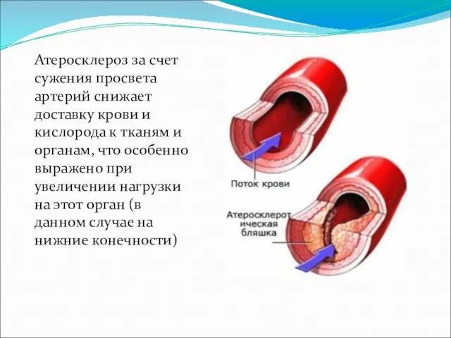 Атеросклероз за счет сужения просвета артерий снижает доставку крови и кислорода к