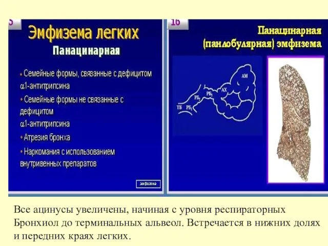 Все ацинусы увеличены, начиная с уровня респираторных Бронхиол до терминальных альвеол. Встречается