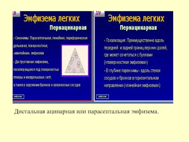 Дистальная ацинарная или парасептальная эмфизема.