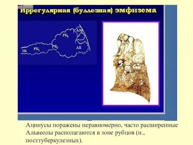 Ацинусы поражены неравномерно, часто расширенные Альвеолы располагаются в зоне рубцов (н., посттуберкулезных).