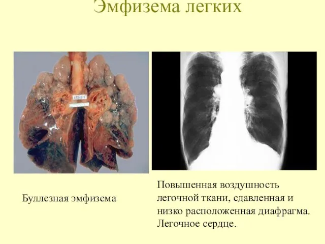 Эмфизема легких Буллезная эмфизема Повышенная воздушность легочной ткани, сдавленная и низко расположенная диафрагма. Легочное сердце.