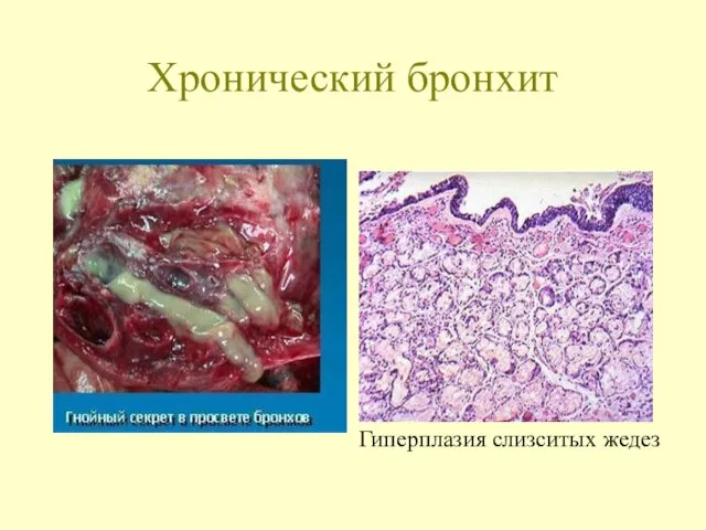 Хронический бронхит Гиперплазия слизситых жедез