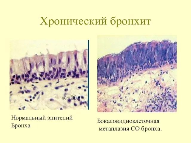 Хронический бронхит Нормальный эпителий Бронха Бокаловидноклеточная метаплазия СО бронха.