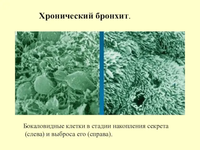 Бокаловидные клетки в стадии накопления секрета (слева) и выброса его (справа). Хронический бронхит.