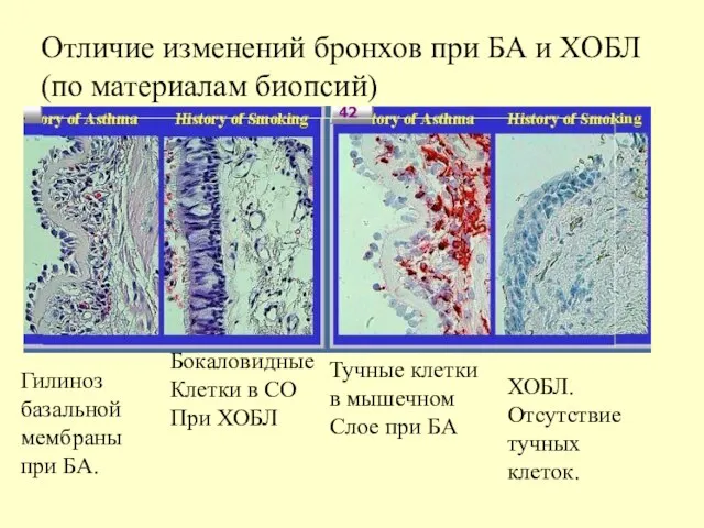 Отличие изменений бронхов при БА и ХОБЛ (по материалам биопсий) Гилиноз базальноймембраны