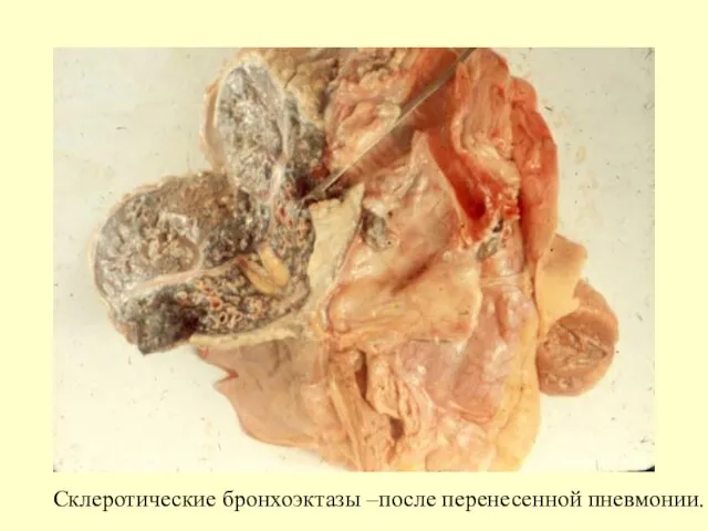 Склеротические бронхоэктазы –после перенесенной пневмонии.