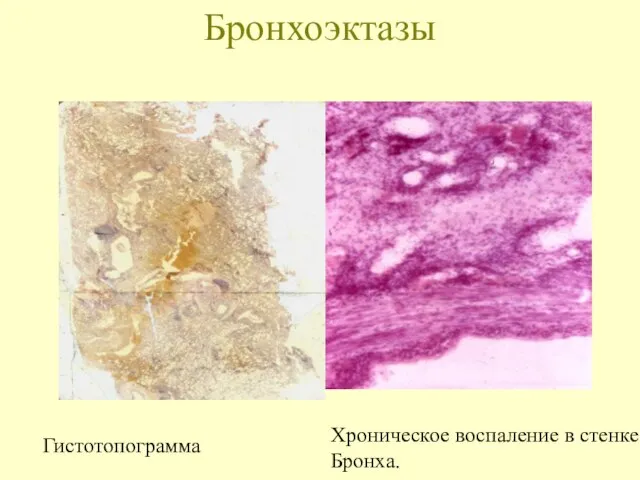 Бронхоэктазы Гистотопограмма Хроническое воспаление в стенке Бронха.