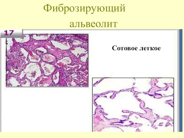 альвеолит Фиброзирующий Сотовое легкое